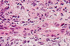Mikroskopický obraz PBC z jaterní biopsie s charakteristickými intraepiteliálními lymfocyty ve žlučových kanálcích
