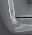 Abnormally pointed radiocapitellar line, indicating radial head dislocation.[4]