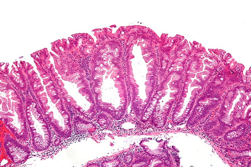 File:Sessile serrated adenoma 2 intermed mag.jpg