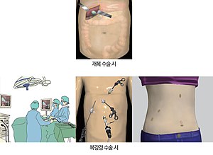 복강경 수술