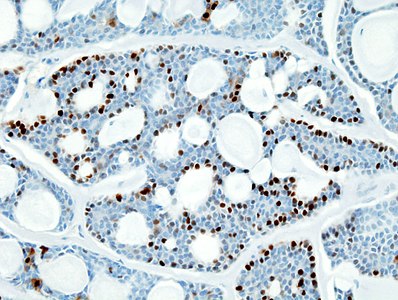 Histopathologisch beeld van adenoïdcystisch carcinoom van de speekselklier, immunokleuring voor S-100-eiwit