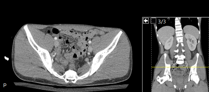 CT of a normal abdomen and pelvis, axial plane 213.png