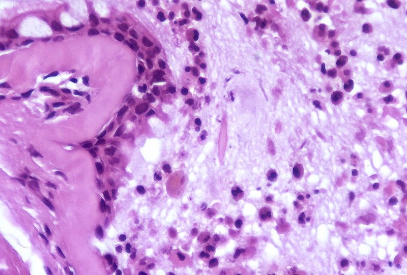 File:Charcot-Leyden crystal - Asthma.jpg