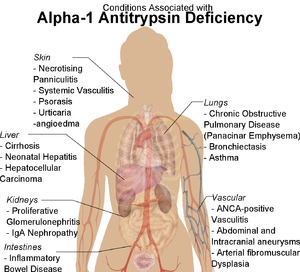Conditions associated with Alpha-1 Antitrypsin Deficiency.png