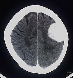 Contrast enhanced meningioma.jpg