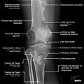 Diagnóstico diferencial em lesões ósseas (mais de 30 anos).jpg