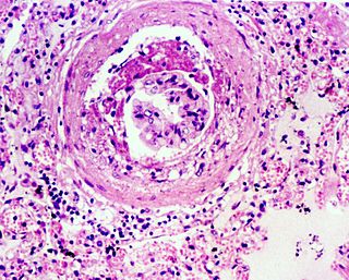 <span class="mw-page-title-main">Glomerulosclerosis</span> Medical condition