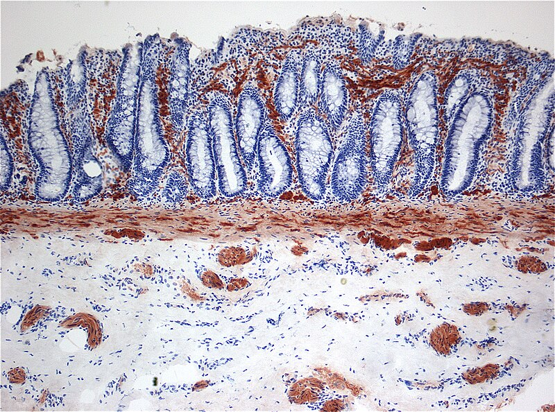 Esempio di biopsia rettale con istopatologia convenzionale con colorazione ematossina-eosina per diagnosticare la malattia di Hirschsprung