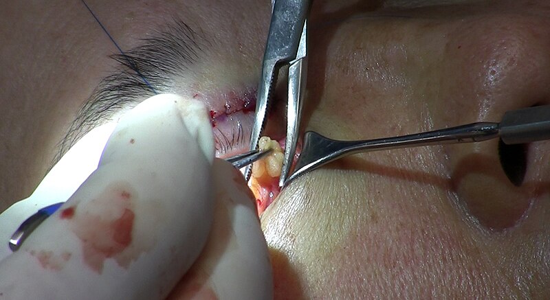 File:Large deposit of fatty tissue exposed for excision during lower eyelid blepharoplasty 3.jpg
