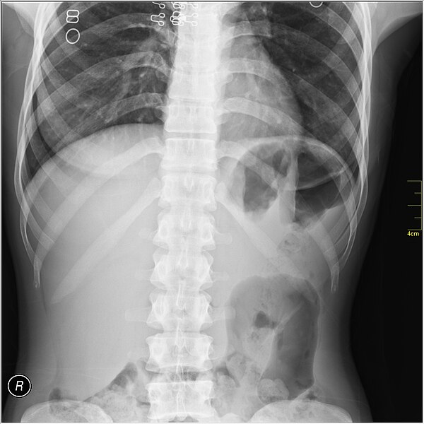 File:Medical X-Ray imaging XBR07 nevit.jpg