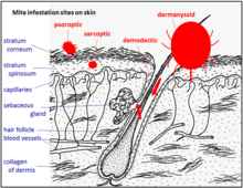 Sites of infestation by mites in skin (mites not at correct scales) Mites-sites-of-infestation-in-skin-2.png