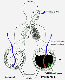 Pneumonija