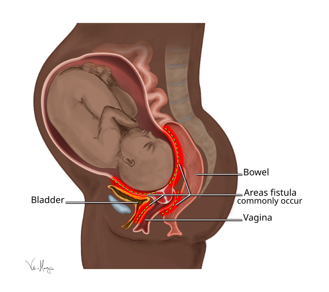 File:Obstetric Fistula Locations.svg