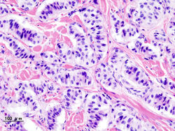 Pancreatic insulinoma (2).JPG