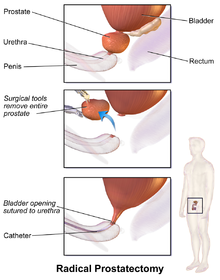 Long term effects of prostate removal.