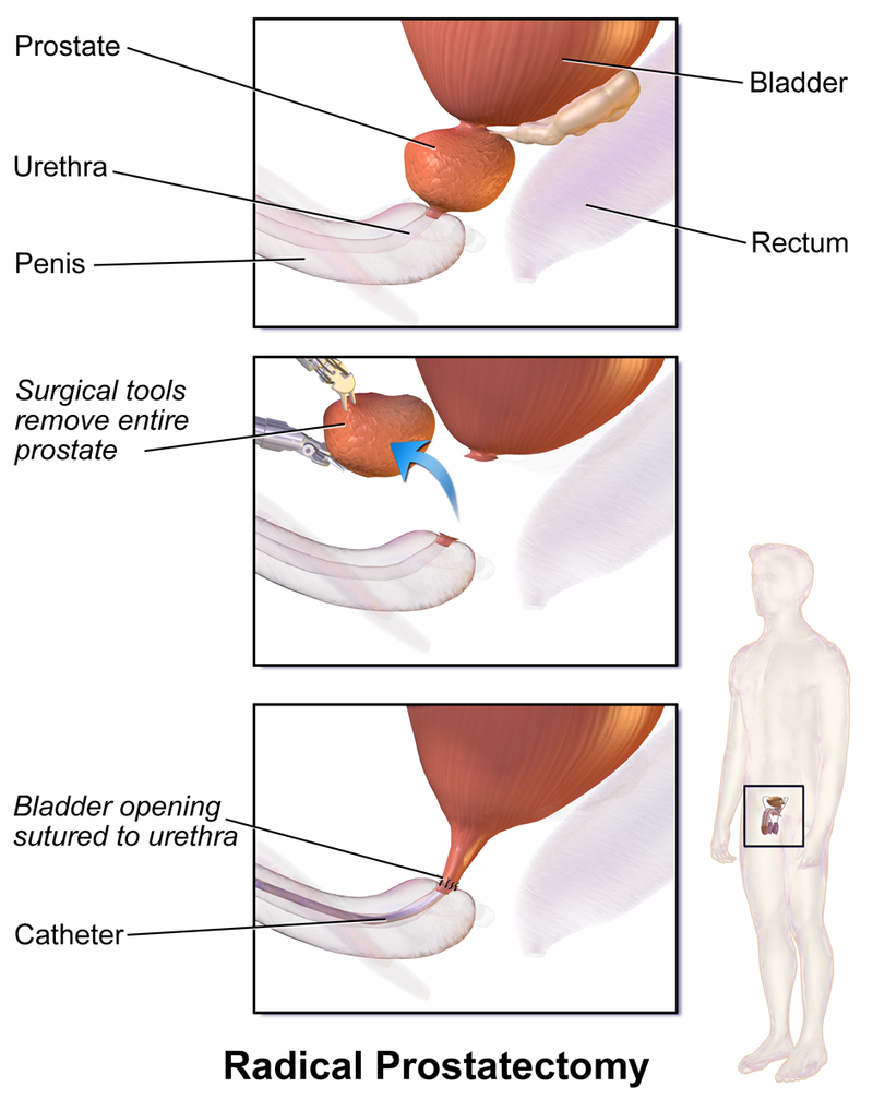 cancer de la prostate wikipedia francais