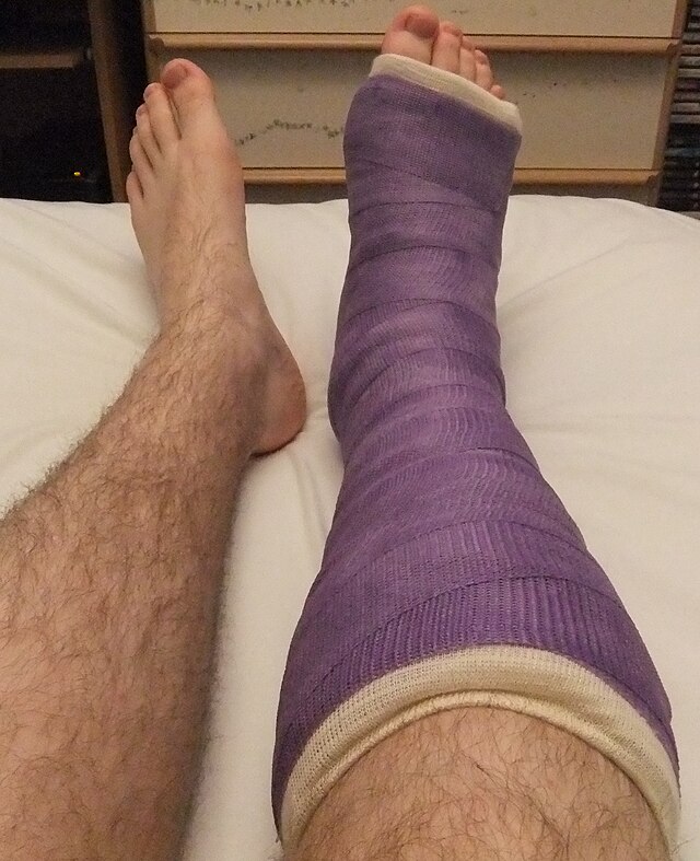 broken ankle cast colors