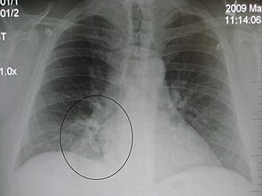 Chest x-ray, showing pneumonia in right lower lobe. RLL pneumoniaM.jpg