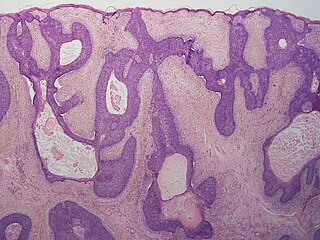 <span class="mw-page-title-main">Basaloid follicular hamartoma</span> Medical condition