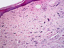 Micrograph of pleomorphic fibroma. Cell-depleted, fibrous connective tissue with atypical fibroblasts SkinTumors-P9290882.jpg