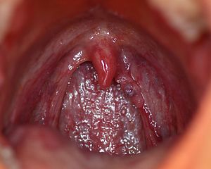 human papillomavirus in throat)