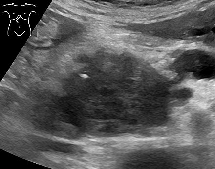 Abdominal ultrasonography of pancreatic cancer (presumably adenocarcinoma), with a dilated pancreatic duct to the right.