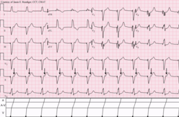 V-rythmé avec 1-to-1 retroconduction.png