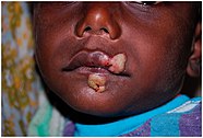 A child with yaws 10.1177 0956462414549036-fig3-Papilloma of primary yaws.jpg