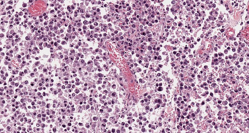 File:Alveolar rhabdomyosarcoma 7.jpg