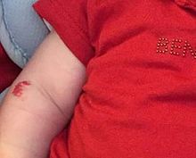 An infantile hemangioma, also called a strawberry angioma, on a child's arm Angioma-fresa.jpg
