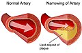 File:Atherosclerosis.jpg (Cc-by-sa-2.0)