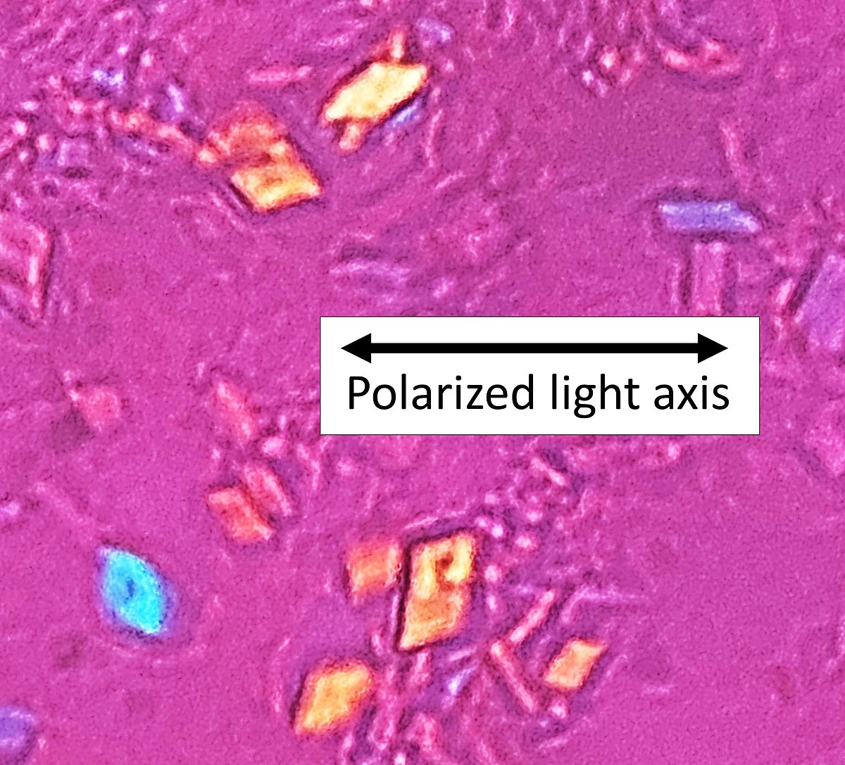 gout vs pseudogout crystals