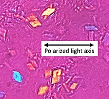 In contrast, CPPD (pseudogout) displays rhombus-shaped crystals with positive birefringence.