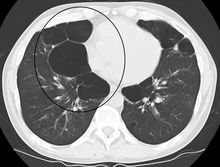 Axial CT image of the lung of a person with end-stage bullous emphysema
