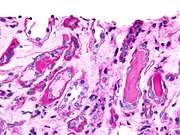 Mikrografija mijelomske gipsaste nefropatije u biopsiji bubrega: Hijalinski gipsaste strukture su pozitivne na PAS (tamno ružičasto/crveno – desno dio slike). Mijelomskii odljevci su PAS negativni (blijedo ružičasti - lijevo od slike), boja PAS.