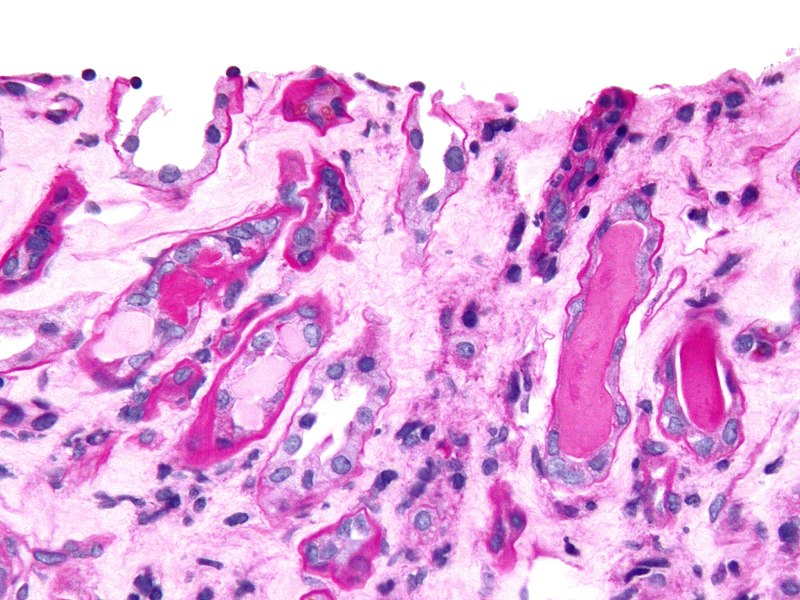 File:Cast nephropathy - 2 cropped - very high mag.jpg