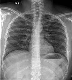 인간의 폐의 X 선