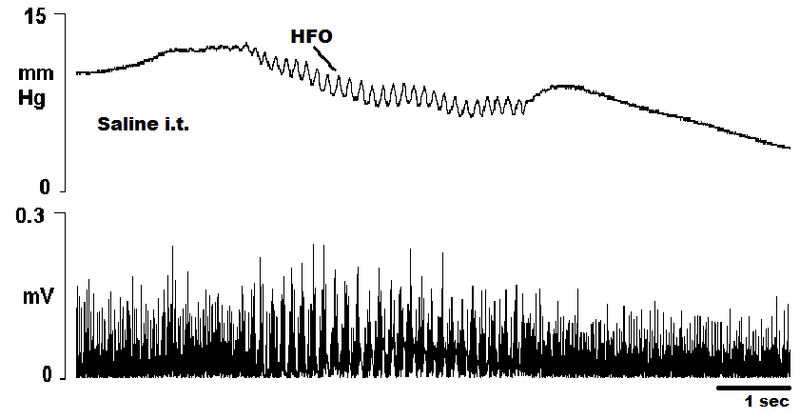 File:Cystometrogram2.png