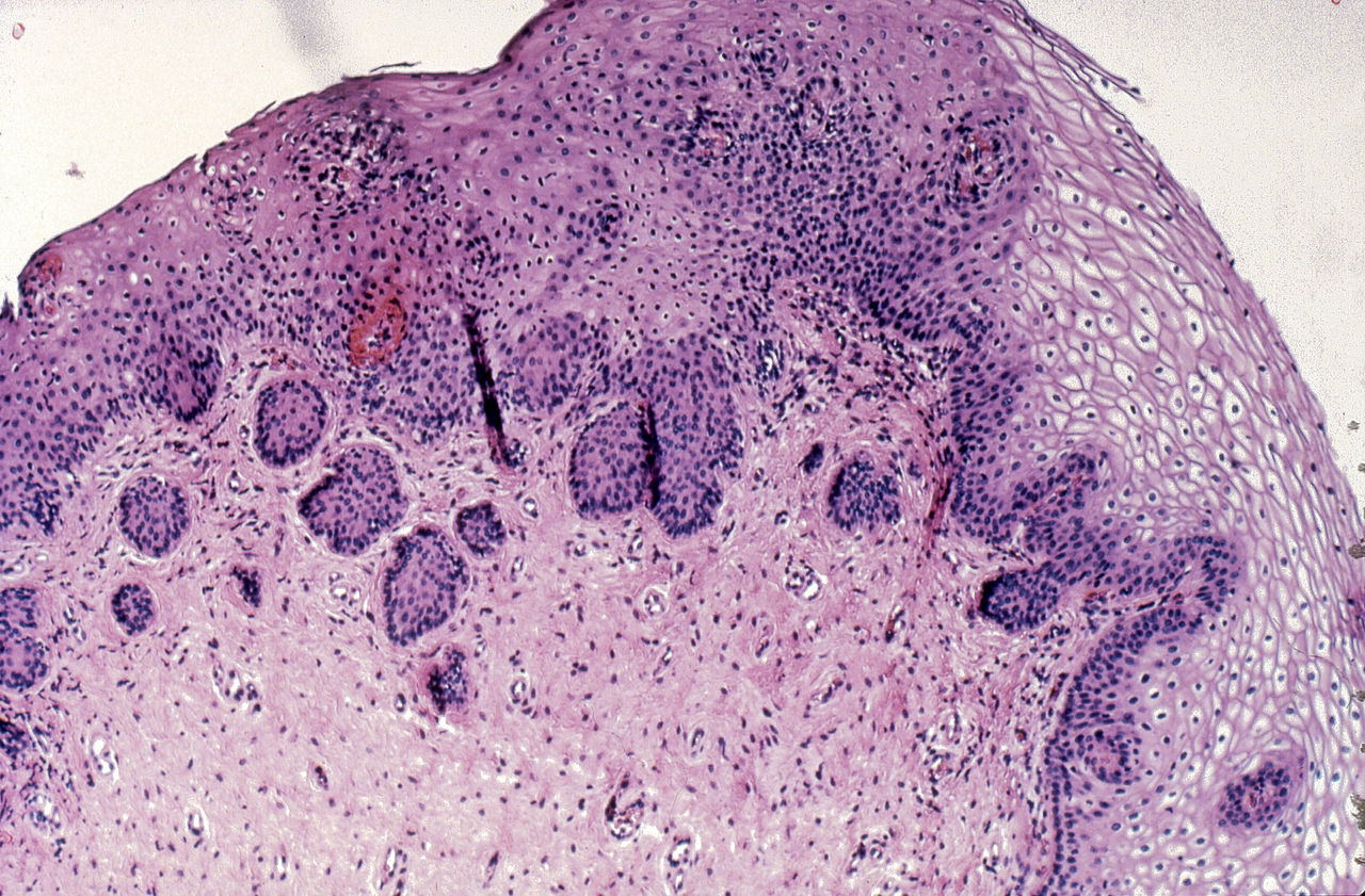 File:Diethylstilbestrol (des) cervix (28).jpg - Wikimedia Commons