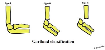 Supracondylar fractures: Gartland classification Gartland Classification.jpg