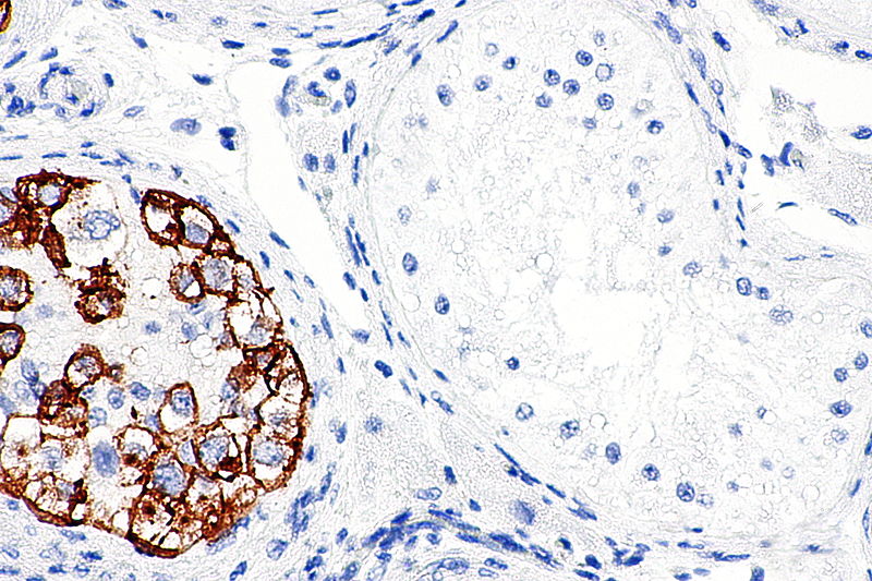 File:ITGCN and Sertoli cells only - PLAP -- high mag.jpg