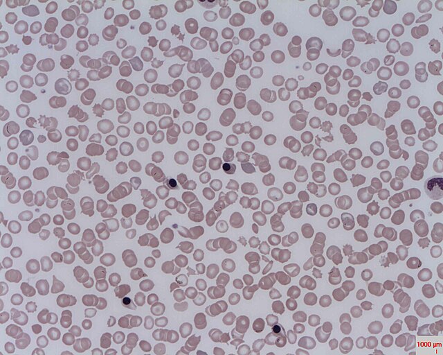 A human peripheral blood smear; NRBCs are visible as larger cells with dark centers.