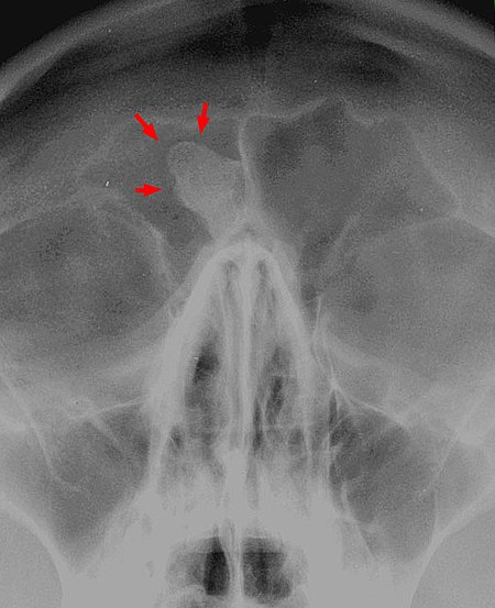 Osteom der Stirnhoehle Roentgen.jpg