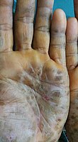 Diffuse palmoplantar keratoderma