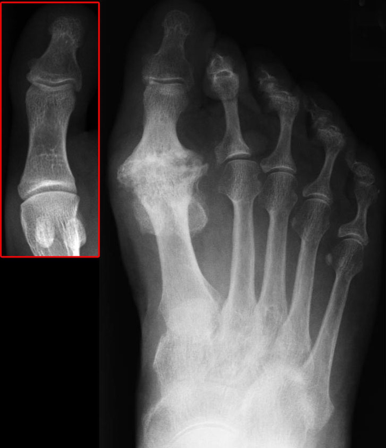 Артрит 1 плюснефалангового сустава рентген