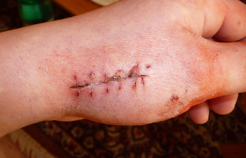 File:Scar on hand after 13 days.jpg