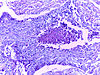 Squamous Cell Carcinoma Lung 20x.jpg