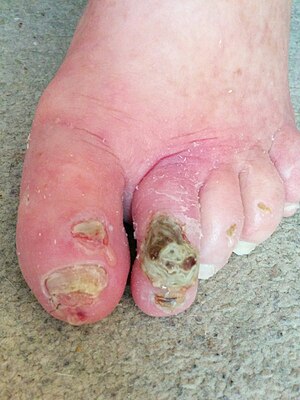 Foot of an 80-year old individual with type 2 diabetes and heart failure. The second toe has a large ischaemic ulcer. The first toe has a small one. Two ischaemic ulcers on the foot of an individual with type 2 diabetes.jpg