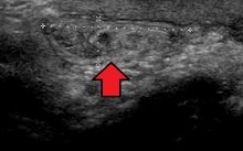 Ultrasound showing an inguinal hernia USofaninguinherniaMark.png