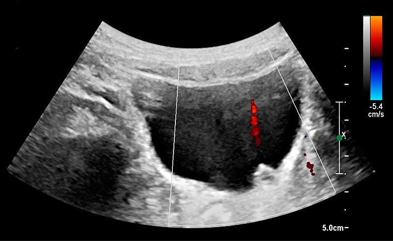 File:Ultrasonography of left hydroureter with ureteric jet.jpg